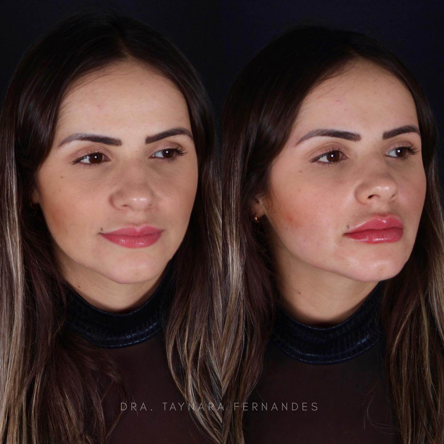 Antes e depois — Preenchimento Labial