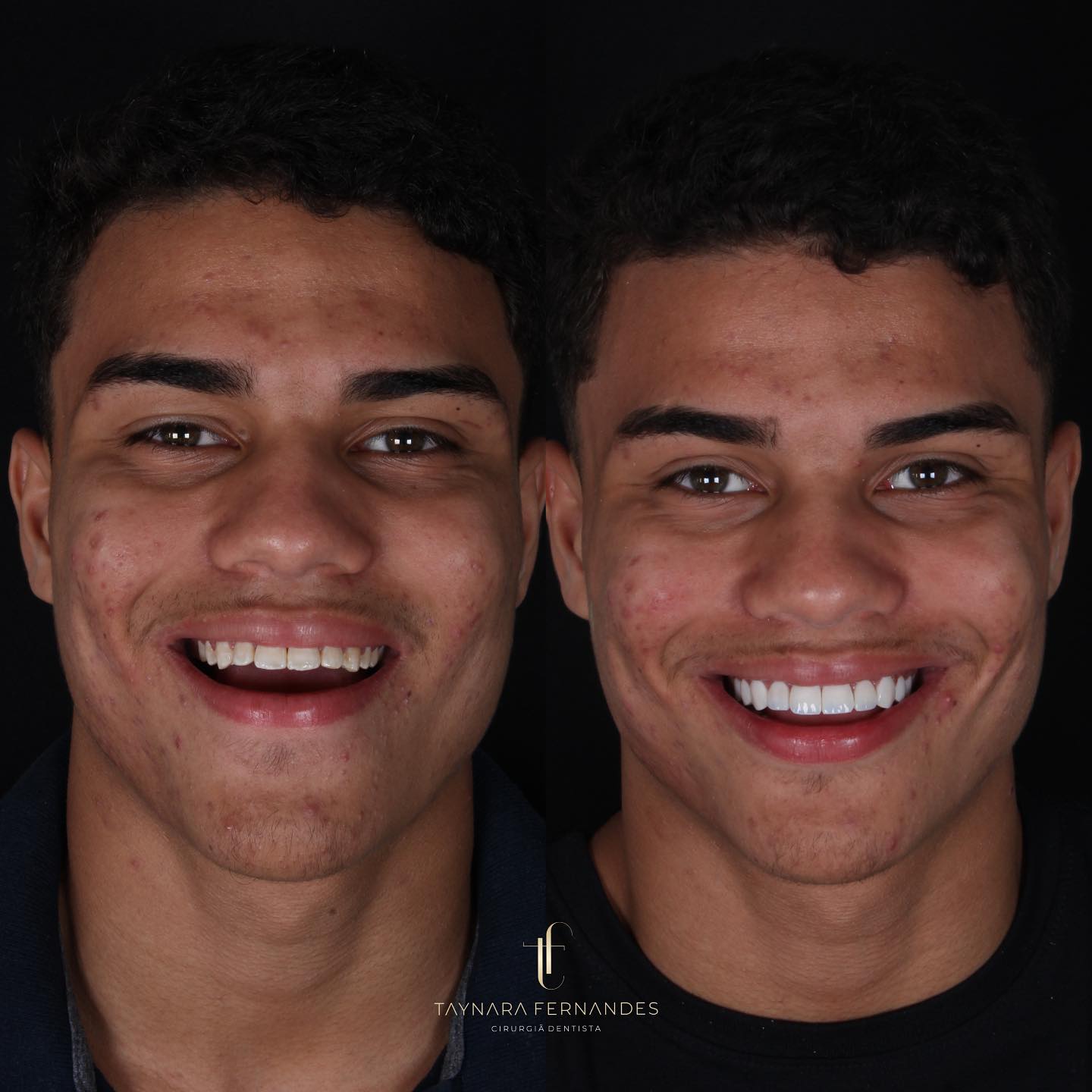Antes e depois — Clareamento e Reabilitação Oral