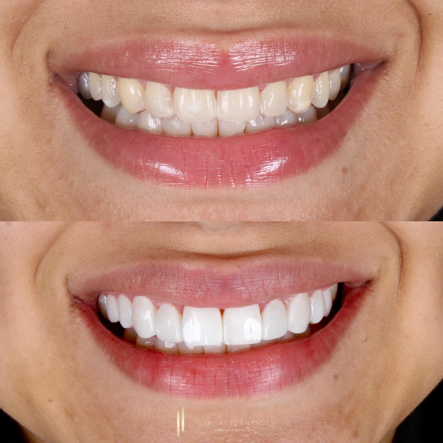 Antes e depois — Clareamento e Facetas de Porcelana